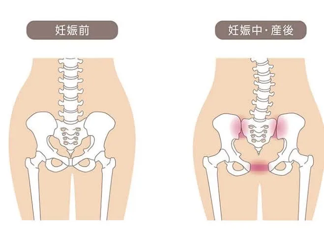 産後の骨盤矯正！腰痛も改善！骨盤のゆがみを整えよう！